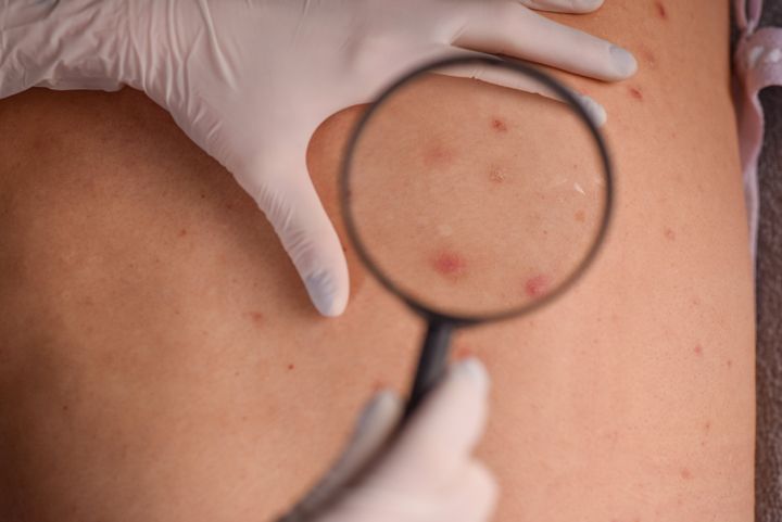 Moles that bleed or scab are definitely a reason to alert your dermatologist.
