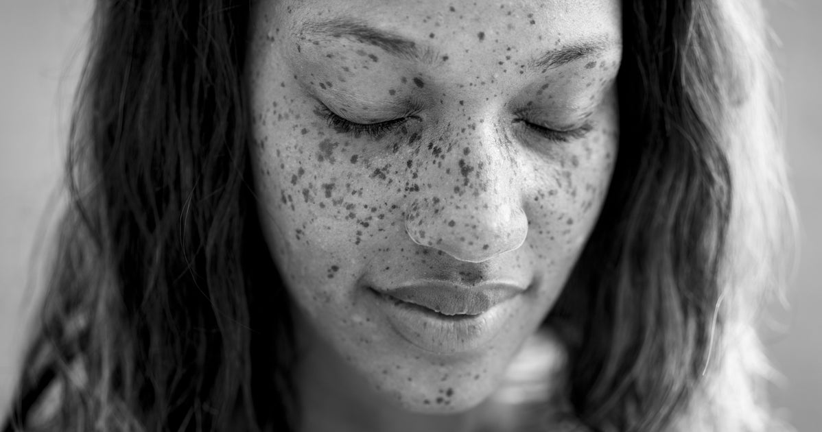 NextImg:The Beautiful Skin Feature More People Are Embracing, Rather Than Removing