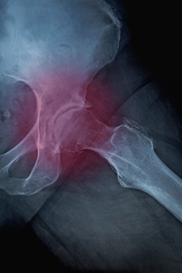 X ray artrosi dell'anca