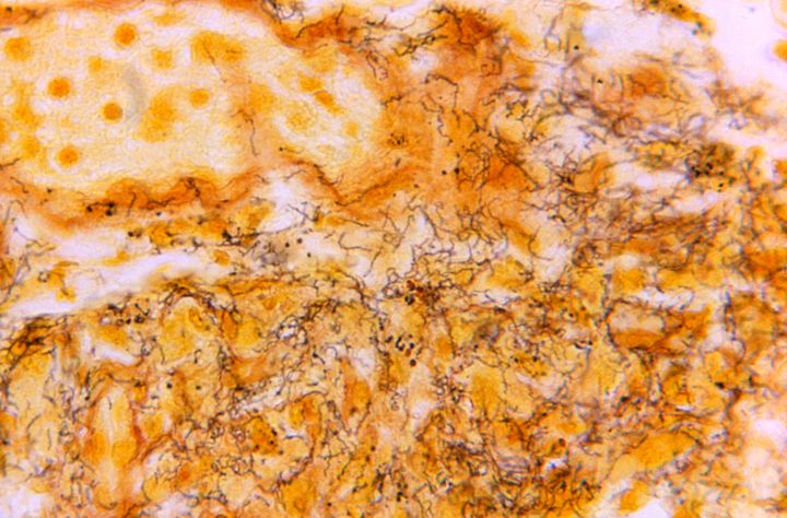 This 1966 microscope photo shows a tissue sample with the presence of numerous corkscrew-shaped, darkly-stained Treponema pallidum spirochetes, the bacterium responsible for syphilis.