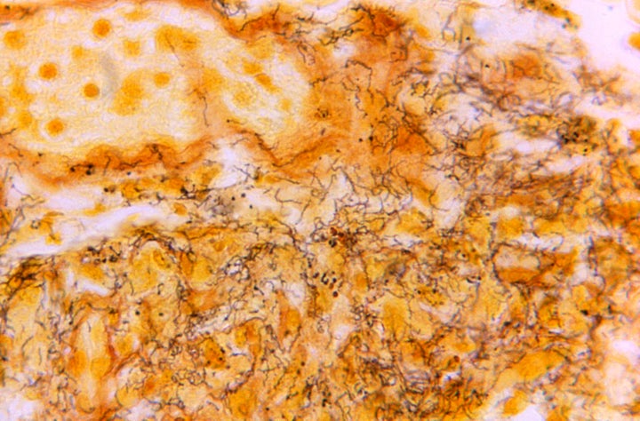 This 1966 microscope photo shows a tissue sample with the presence of numerous corkscrew-shaped, darkly-stained Treponema pallidum spirochetes, the bacterium responsible for syphilis.