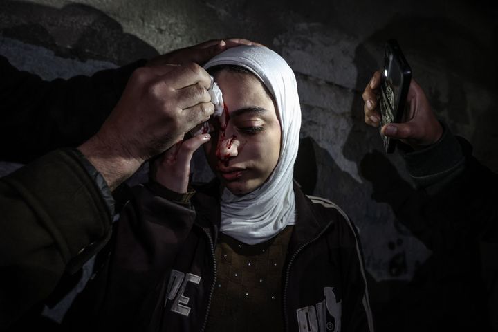 イスラエルの攻撃で怪我をして治療を受けるパレスチナの若い女性（2024年2月19日）