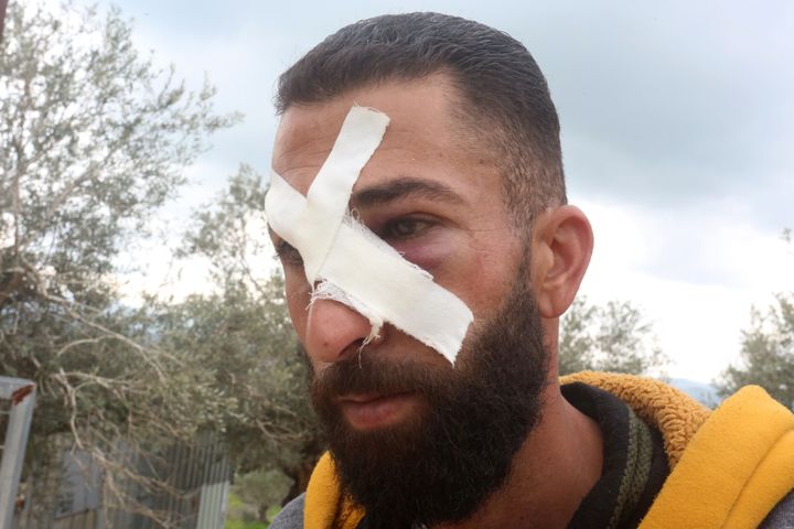 A Palestinian who got injured after the raids and attacks of Israeli forces and Jewish settlers is seen with bandage on his face in the village of Burqa in Nablus, West Bank, on Feb. 20. It was stated that 7 Palestinians were injured in raids and attacks in Nablus and Tulkarem cities of West Bank.