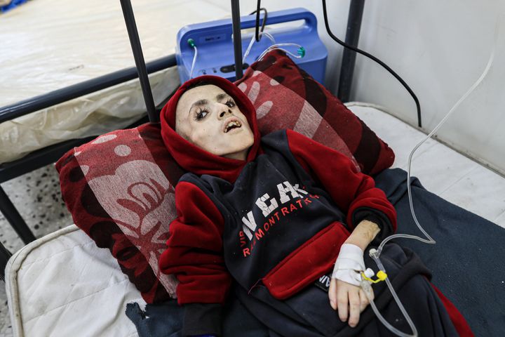 Yazan al-Kafarneh, a 10-year-old Palestinian boy, receives medical treatment with limited resources at Abu Yusuf al-Najjar Hospital in Rafah, Gaza, on Feb. 28. Yazan died of severe malnourishment on March 4.