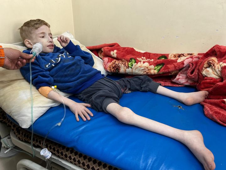 O Φαντί Αλ Ζαντ, 6 ετών, σοβαρά υποσιτισμένος στο νοσοκομείο Καμάλ Αντουάν στην Γάζα (10 Μαρτίου 2024) 