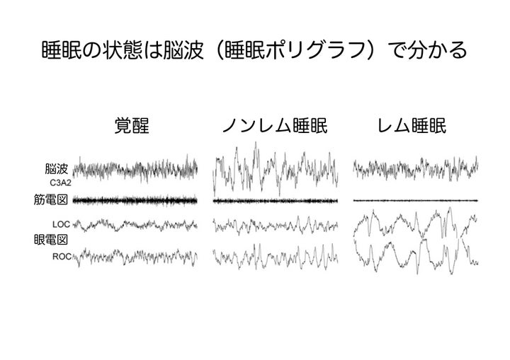 資料②「睡眠の状態は脳波（睡眠ポリグラフ）で分かる」