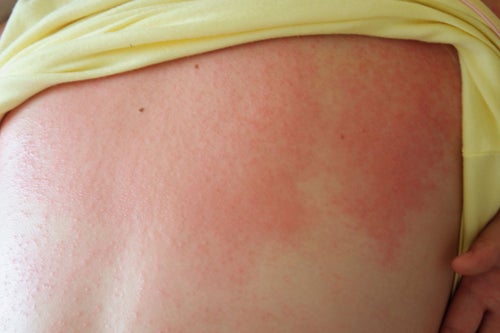 Heat Rash Baby Back