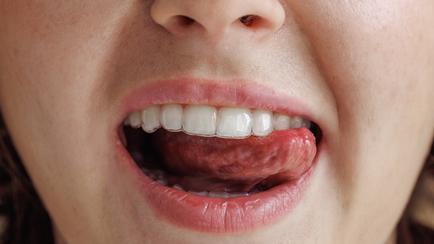 Do You Have A 'Scalloped Tongue'? Here's What It Says About Your Health.