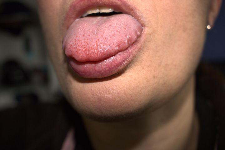 A scalloped tongue has indentations from the teeth along the sides.