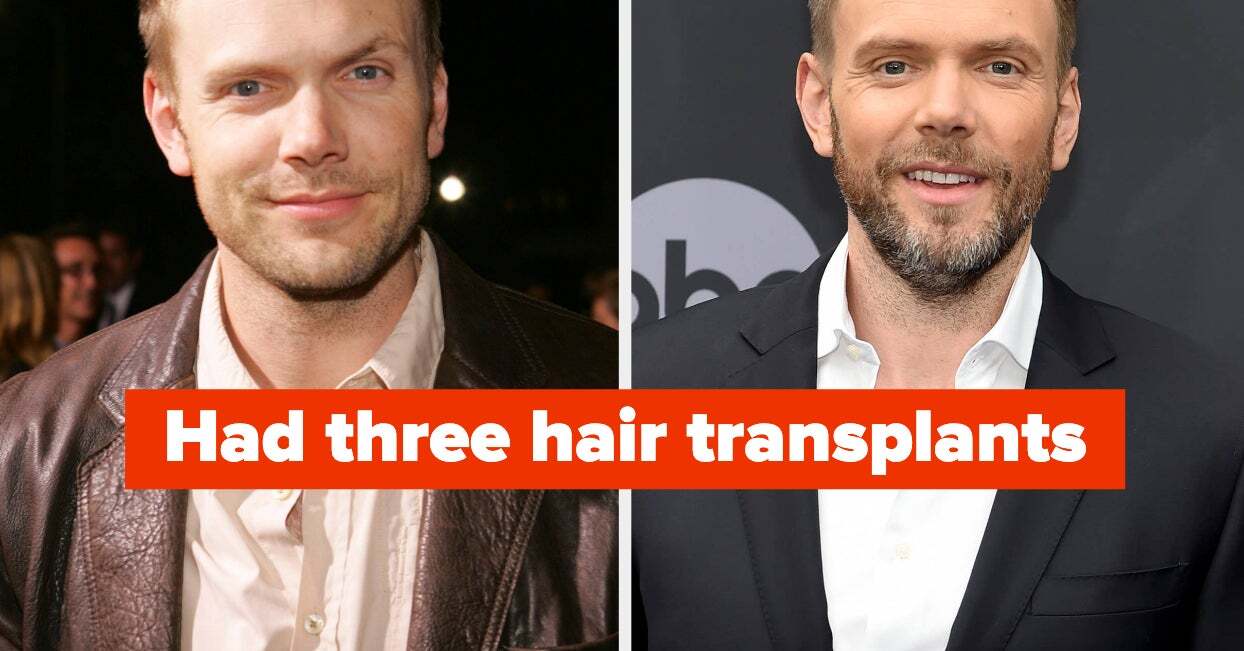 Male Celebs Who Have Been Candid About Using Wigs And Surgery To