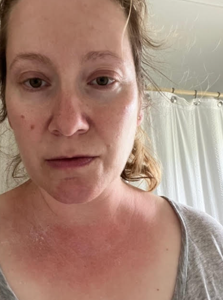 The author’s rashes are pictured in July 2023.