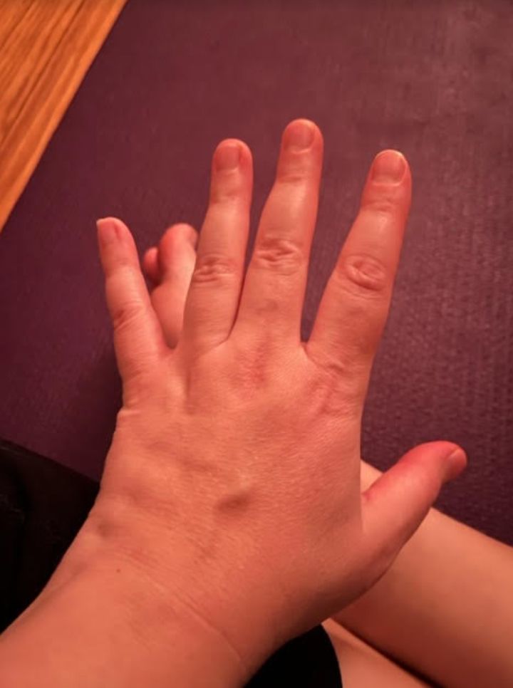 一张照片显示提交人的双手肿胀，这是她狼疮的症状。