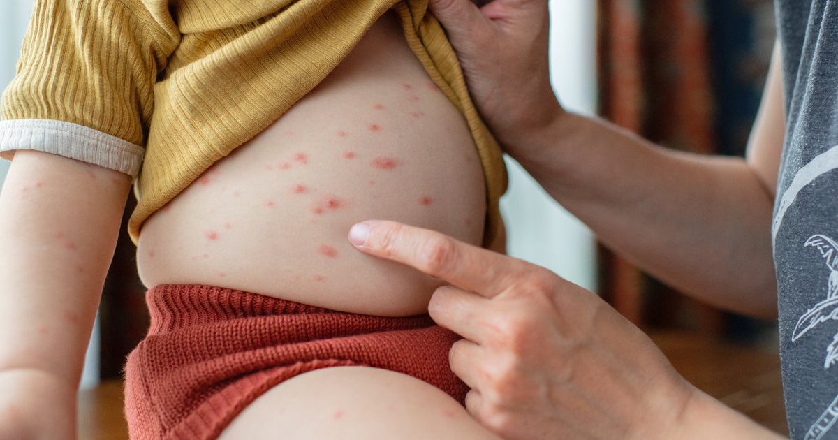 1 Thing You Should NEVER Do If Your Child Has Chickenpox - Vimarsana News