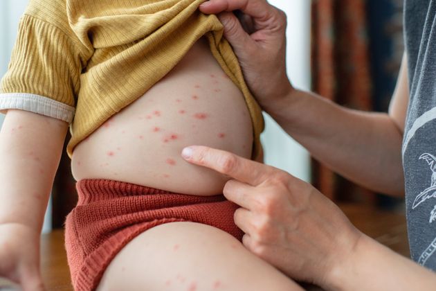 Little girl with chickenpox at home