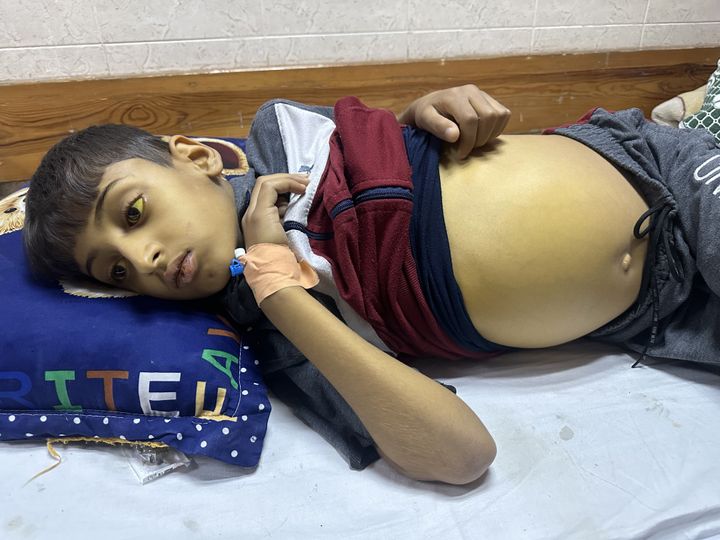 Nine-year-old Palestinian boy Khalid Akl, suffering from hepatitis, lies on a stretcher in the corridor of the Al-Aqsa Martyrs Hospital while the Israeli army's bombardment of the Gaza Strip continues in Deir Al-Balah, Gaza on May 8, 2024. 