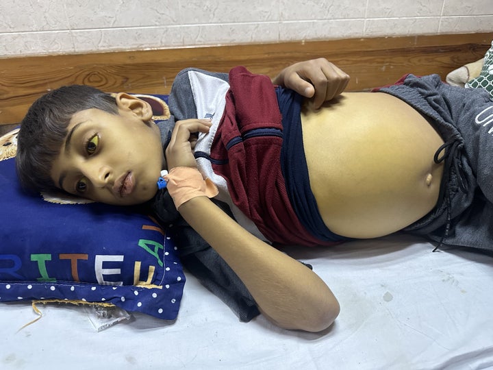 Khalid Akl, a 9-year-old Palestinian boy suffering from hepatitis, lies on a stretcher in the corridor of the Al-Aqsa Martyrs Hospital while the Israeli army's bombardment of the Gaza Strip continues in Deir Al-Balah on May 8, 2024. Khalid, who has yellow eyes and a swollen abdomen due to his illness, cannot find medicine due to limited resources in Gaza.