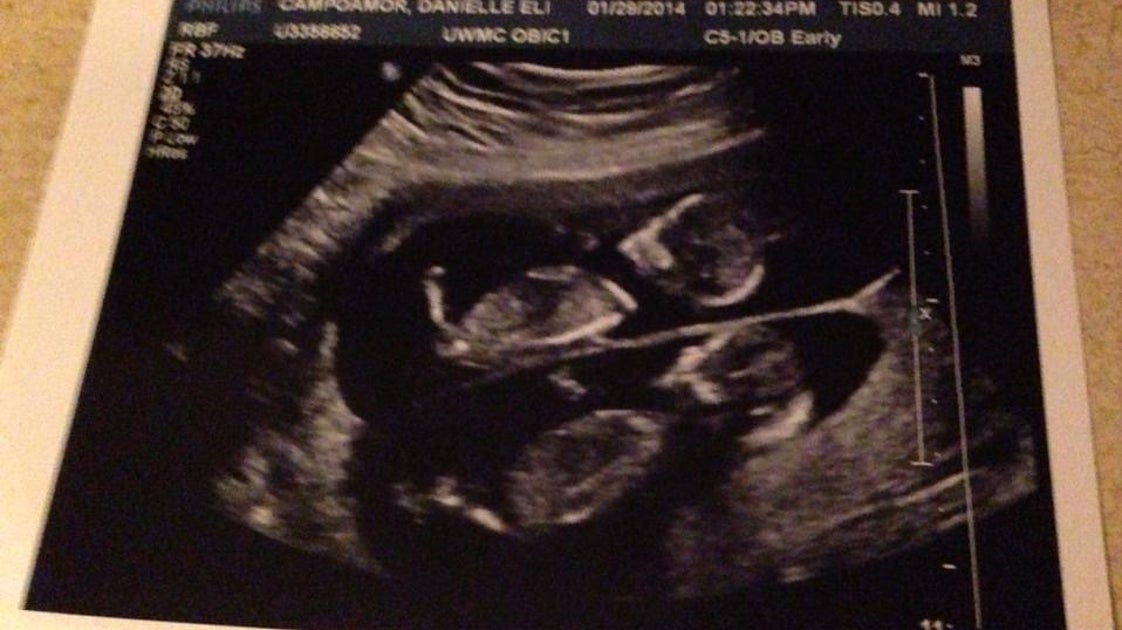 Patient Shares Experience With Selective Reduction in Twin Pregnancy