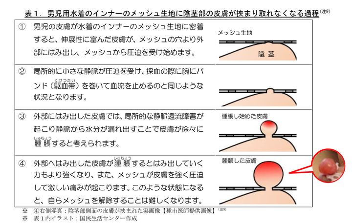 陰茎部の皮膚が挟まり取れなくなる過程