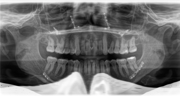 A panoramic X-ray of the author's teeth and jaws taken in 2019.