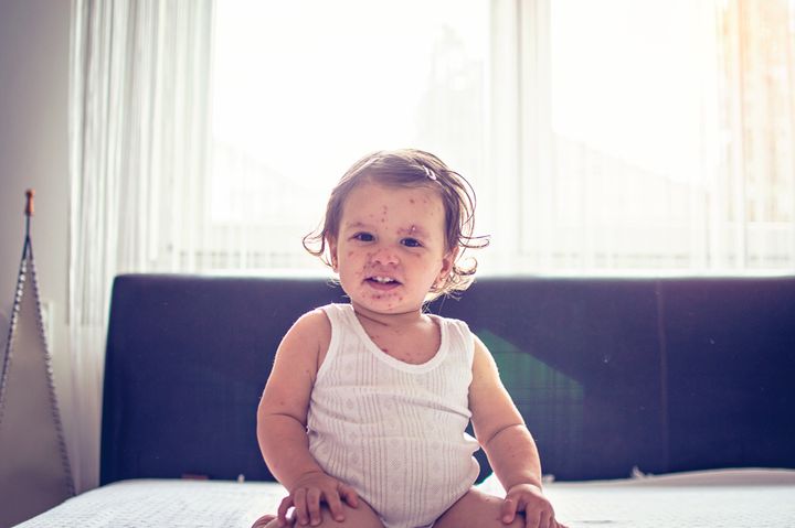 Little girl with measles