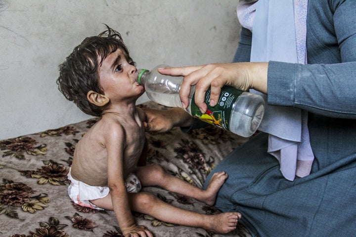 Amjad Al-Qanoo, a 3-year-old Palestinian child whose health is deteriorating due to malnutrition, pictured in Gaza City's Jabalia district on June 9, 2024. 