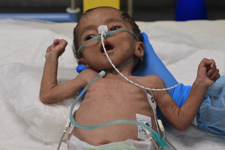 A Palestinian child suffering from malnutrition is treated at the Nasser Hospital in Khan Younis, in the southern Gaza Strip on July 10, 2024. Independent UN rights experts said on July 9, 2024, that Israel was conducting a 