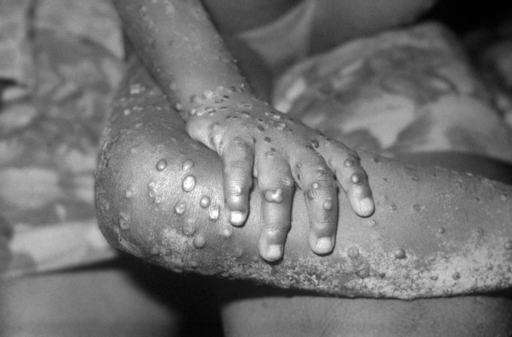 View of the right hand and leg of a 4-year-old girl in Bondua, Grand Gedeh County, Liberia, showing numerous maculopapular lesions of monkeypox.