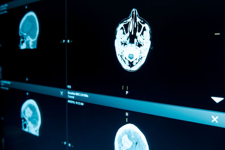 Monitor showing magnetic resonance imaging (MRI) brain scans.