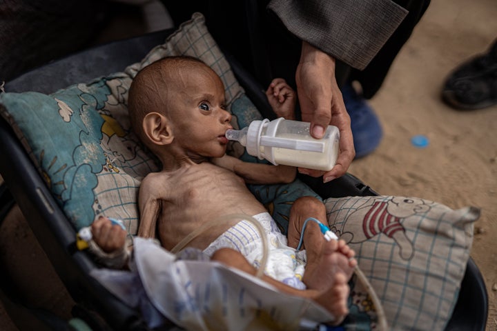 Atef Tayeh, a 6-month-old Palestinian baby photographed on Sept. 12, 2024, who fled with his family from northern Gaza to Deir al-Balah due to Israeli attacks, is in danger of dying of malnutrition.