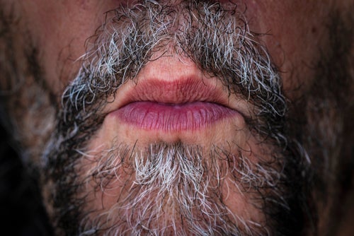 Graying and patchiness tend to happen at the same time, but they're not mutually exclusive.