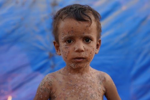 Fayez, a Palestinian boy, awaits treatment for the skin disease that covers most of his body on Sept. 4, 2024. In Gaza under Israeli attacks, the risk of spreading diseases is increasing due to the disruption of health care facilities, water and sanitation systems.