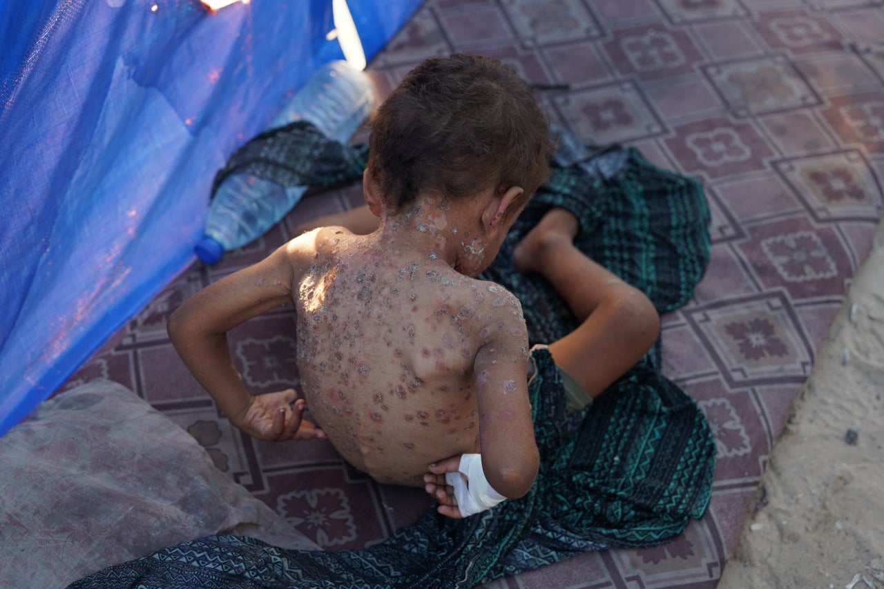 A Palestinian boy, Fayez, waits on Sept. 4 to be treated for a skin disease that covers most of his body in Deir al-Balah, Gaza.