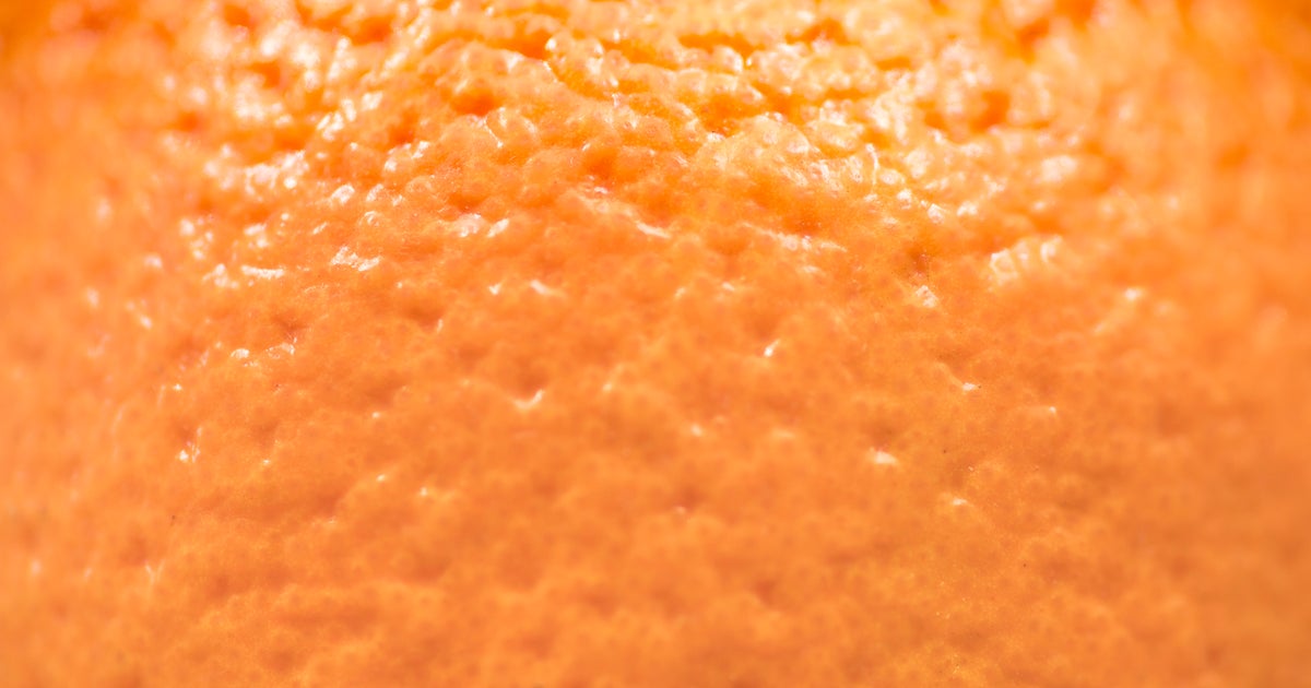 NextImg:So THAT’s Why More Women Have More Cellulite Than Men Do