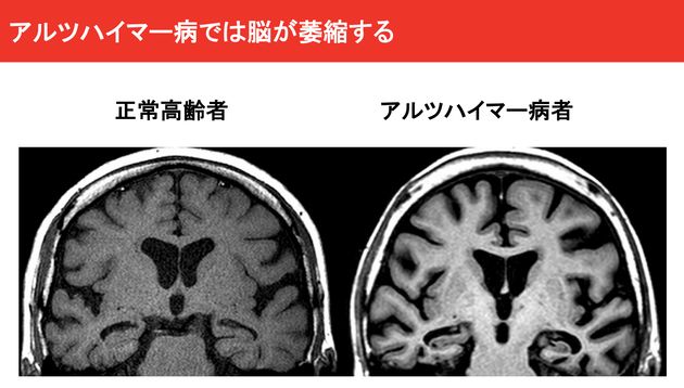 正常高齢者とアルツハイマー患者の脳の比較