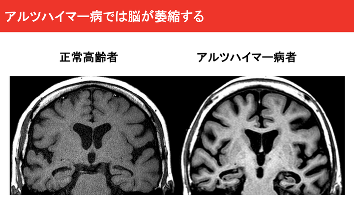 正常高齢者とアルツハイマー患者の脳の比較