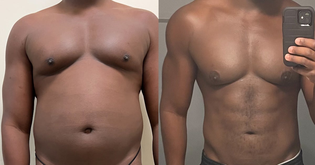 NextImg:This Plastic Surgery Is Becoming More Popular With Men... And You Can See Why