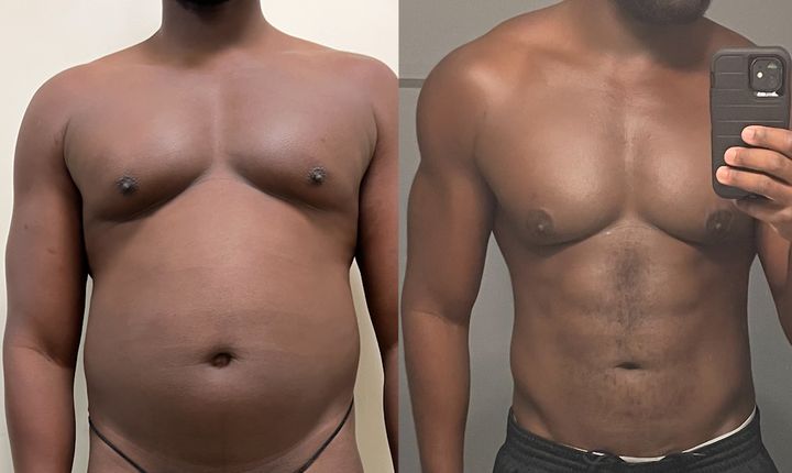 A person is pictured before and after abdominal etching.