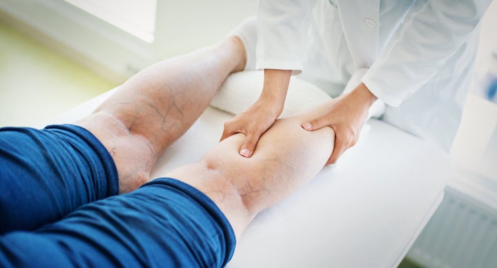 Although genetics and aging are major factors in the development of varicose veins, there are things you can do to slow the process. 