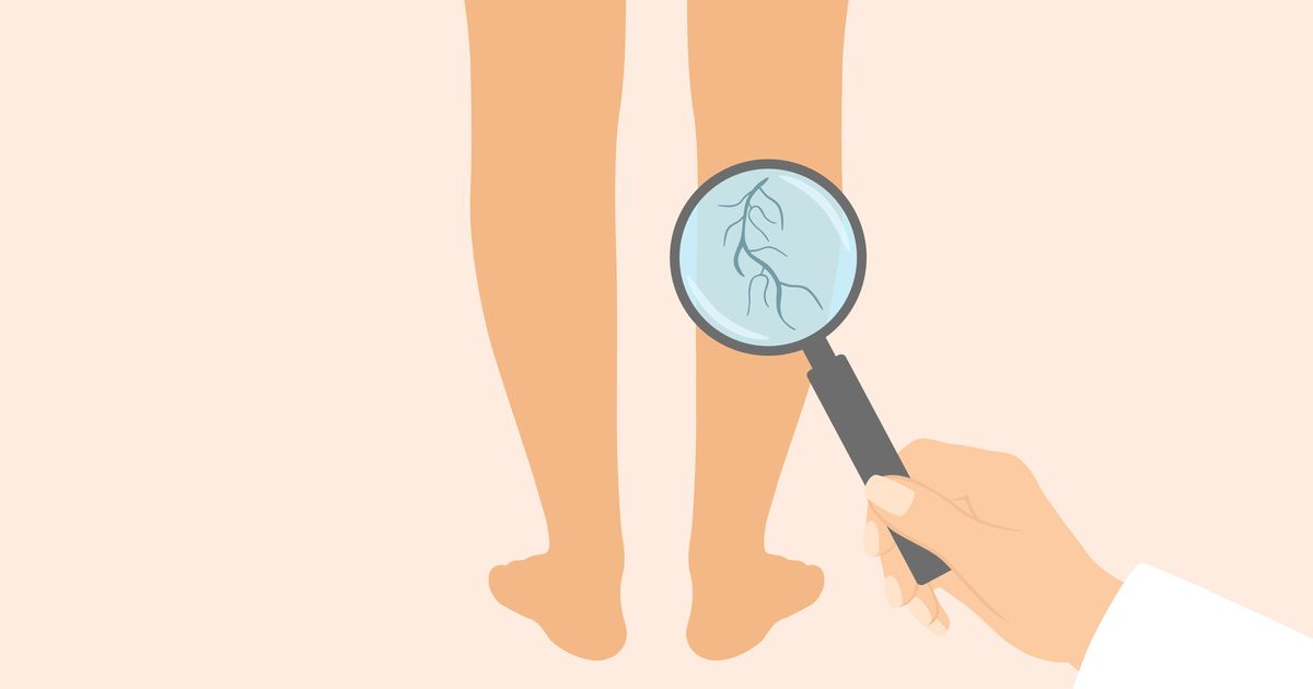 Can You Stop Varicose Veins From Forming? Here's What Doctors Say.