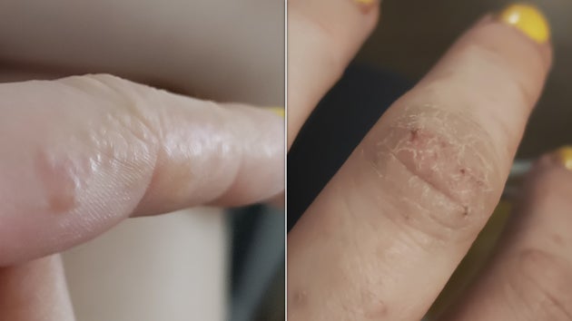  with cracked skin at a later stage, right