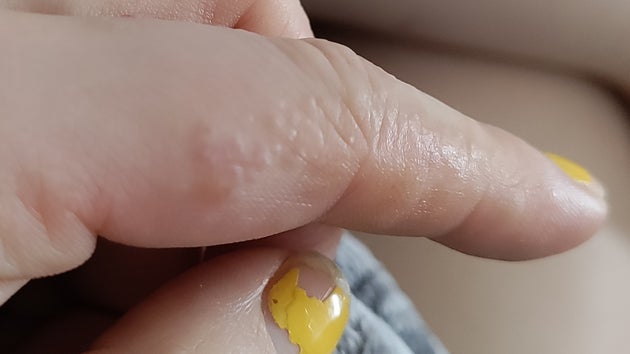 Finger covered in tiny bumps