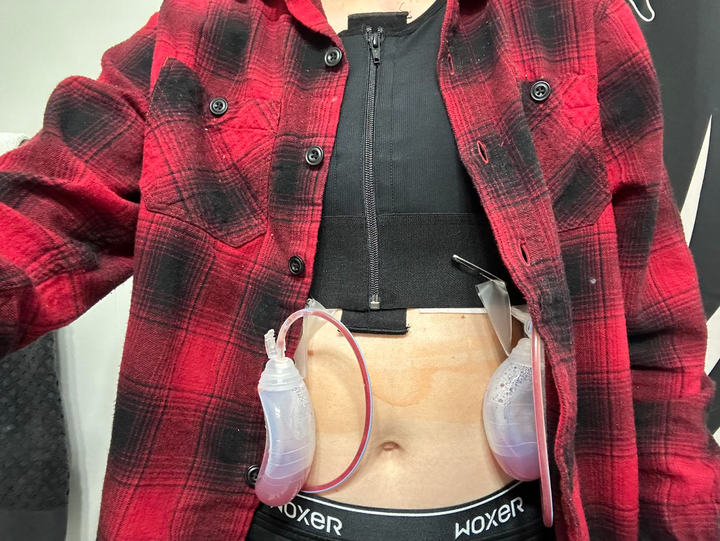 The author one day post-top surgery with their chest still bound and drains collecting blood.
