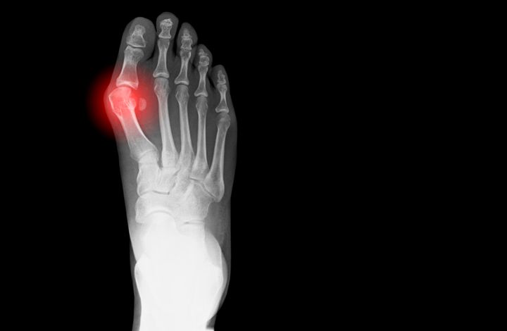 An X-ray shows a bunion on a foot.