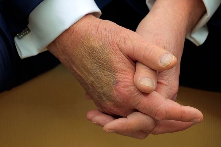 Makeup appears to cover a bruise on the back of President Donald Trump's hand as he hosts French President Emmanuel Macron for meetings at the White House on Feb. 24, 2025.