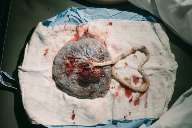 A placenta after birth