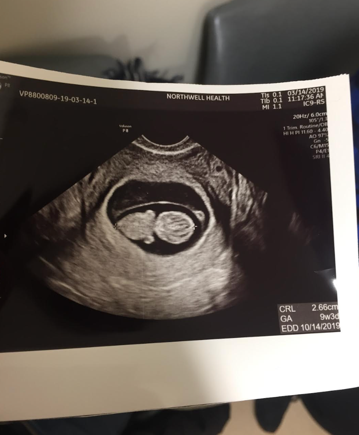 The ultrasound photo that inspired the nickname Baby Watermelon Head.