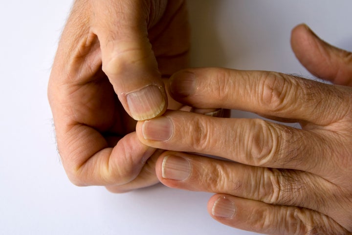 Nails can split for a variety of reasons, experts say.
