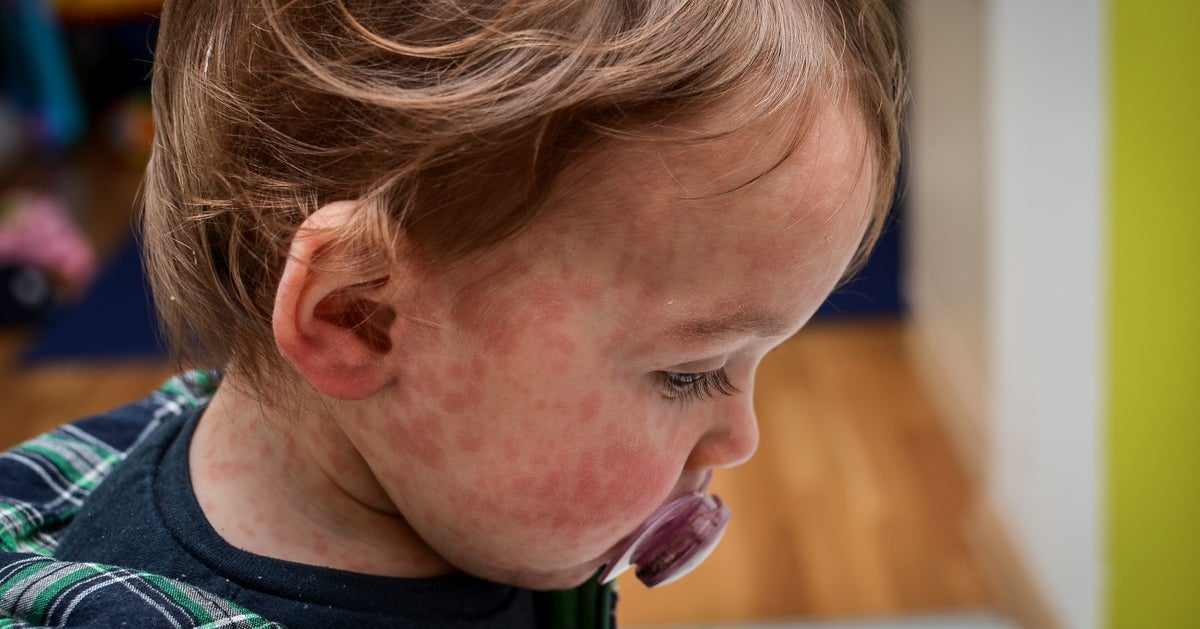 UK's Health Agency Warns Children Hospitalised Amid London Measles Outbreak