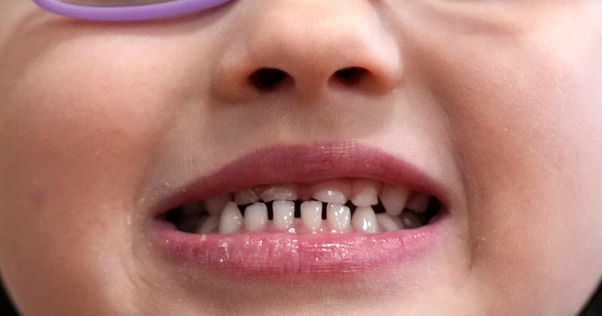 FDA, RFK Jr. Begin Effort To Remove Ingestible Fluoride Products From Market