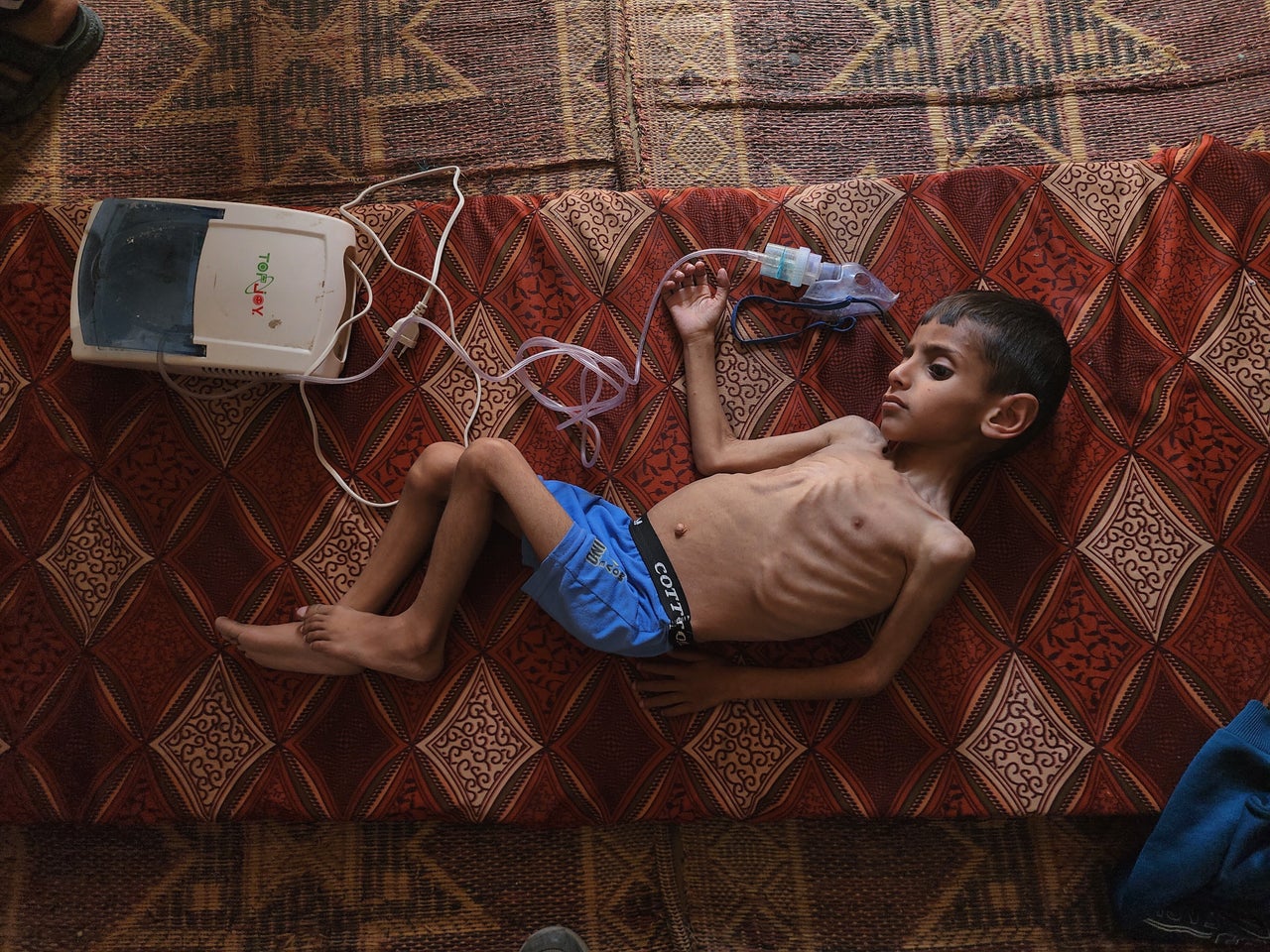 Osama Kamal Al Rakab suffers from malnutrition in the town of Beni Suheyl, in Khan Yunis, Gaza, on April 14. Israel's total blockade of food and humanitarian assistance has led to the mass starvation of Palestinian children.